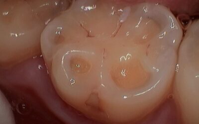 GERD’s Effects on Teeth