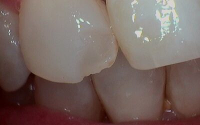 Case Study: Immediate Fracture Repair